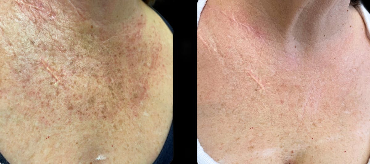 IPL Before & After Gallery - Patient 104043 - Image 1