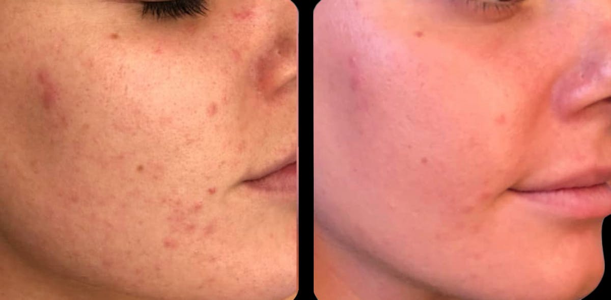 IPL Before & After Gallery - Patient 392592 - Image 1