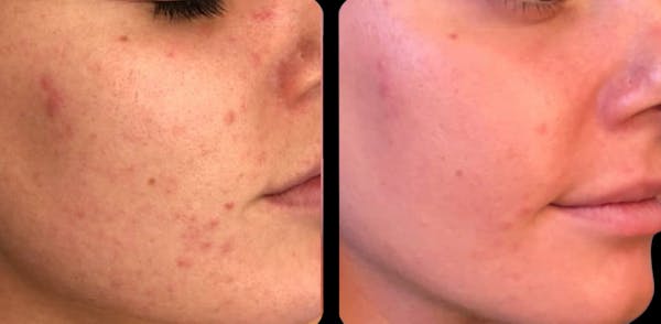 IPL Before & After Gallery - Patient 392592 - Image 1