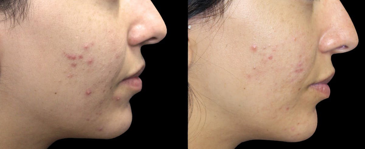 IPL Before & After Gallery - Patient 184272 - Image 1