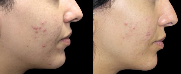 IPL Before & After Gallery - Patient 184272 - Image 1