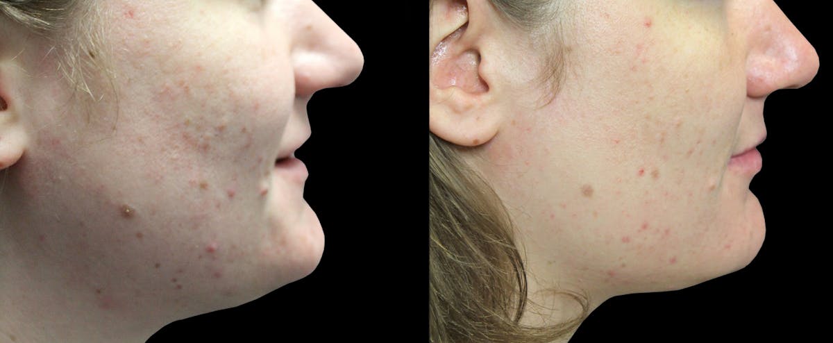 IPL Before & After Gallery - Patient 200610 - Image 1