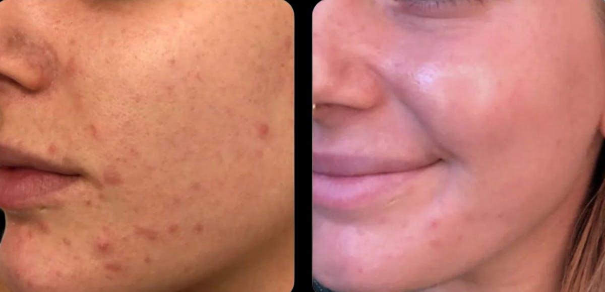 IPL Before & After Gallery - Patient 143673 - Image 1