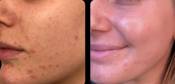IPL Before & After Gallery - Patient 143673 - Image 1