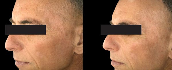 IPL Before & After Gallery - Patient 342755 - Image 1