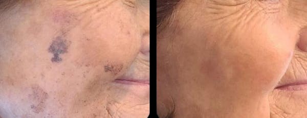 IPL Before & After Gallery - Patient 163923 - Image 1
