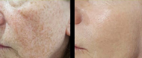 IPL Before & After Gallery - Patient 344159 - Image 1
