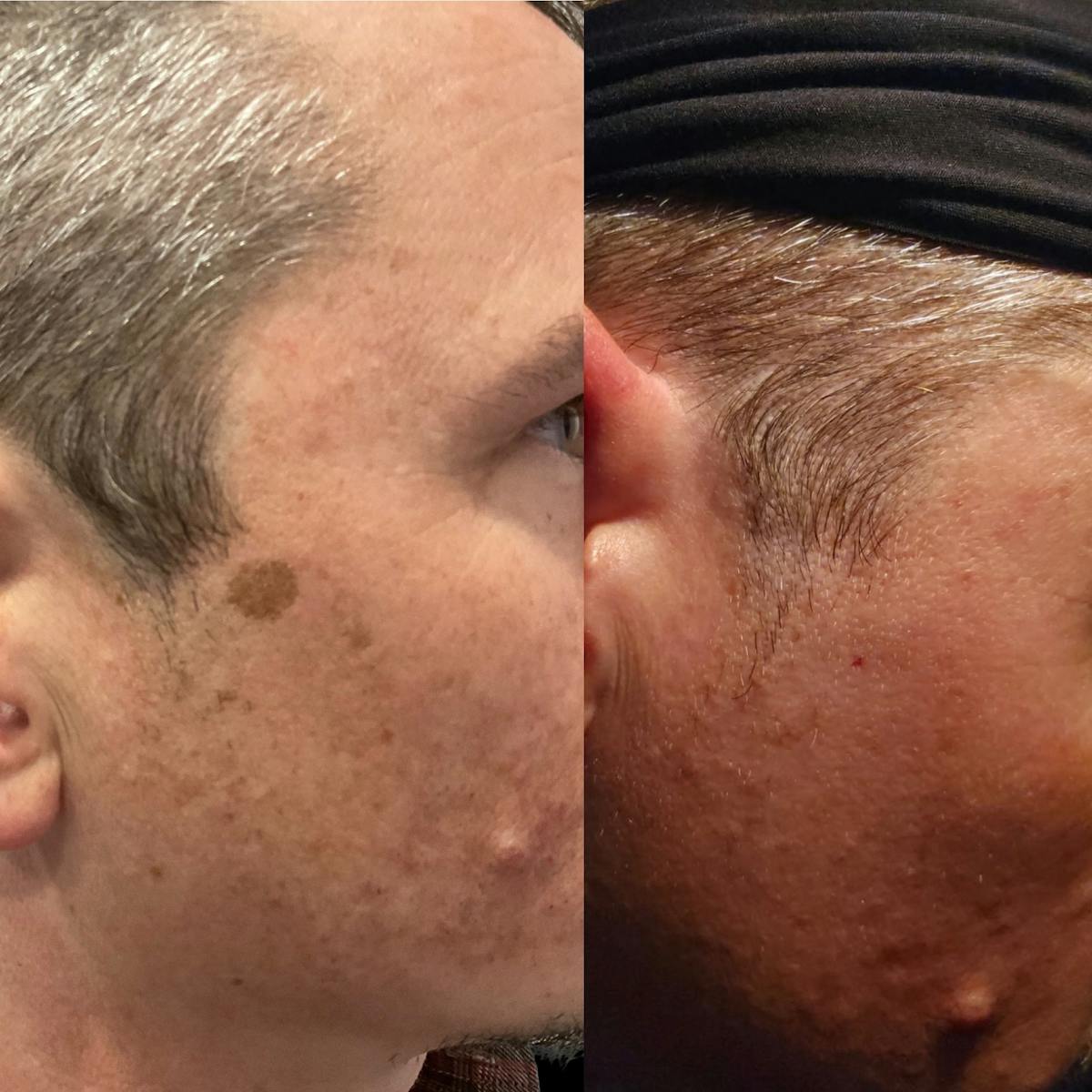 IPL Before & After Gallery - Patient 174712 - Image 1