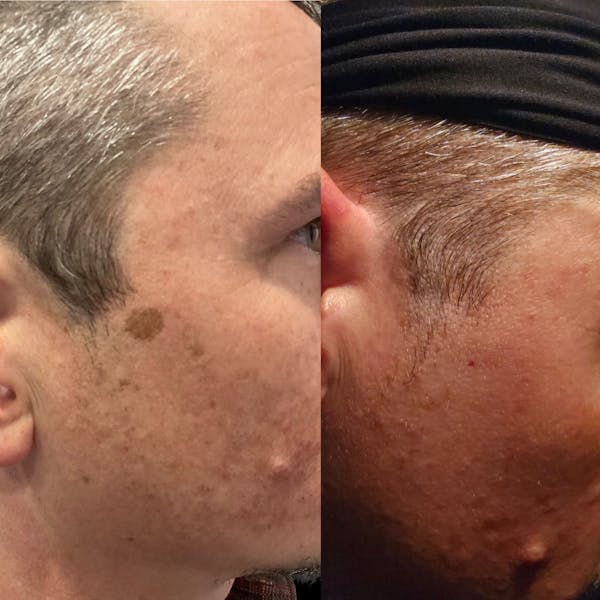 IPL Before & After Gallery - Patient 174712 - Image 1