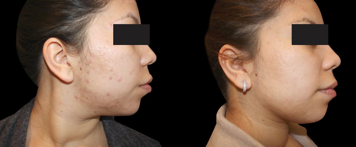 IPL Before & After Gallery - Patient 378392 - Image 1