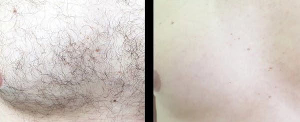 Laser Hair Removal Before & After Gallery - Patient 861334 - Image 1