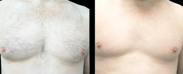 Laser Hair Removal Before & After Gallery - Patient 353386 - Image 1