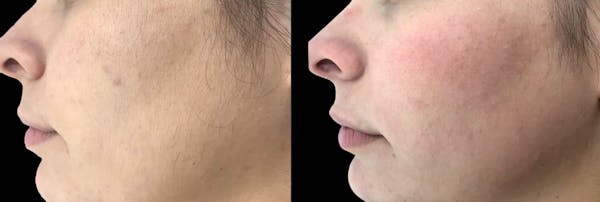 Laser Hair Removal Before & After Gallery - Patient 351610 - Image 1