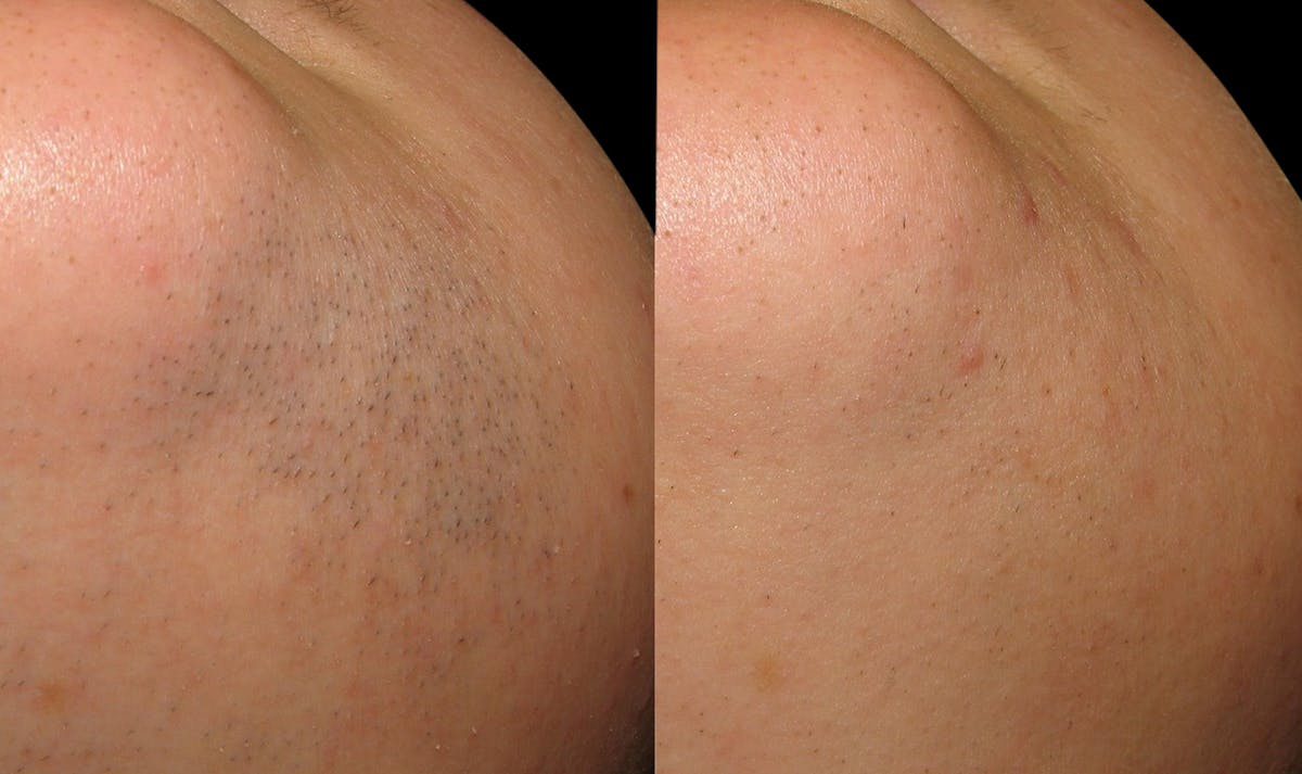 Laser Hair Removal Before & After Gallery - Patient 258233 - Image 1