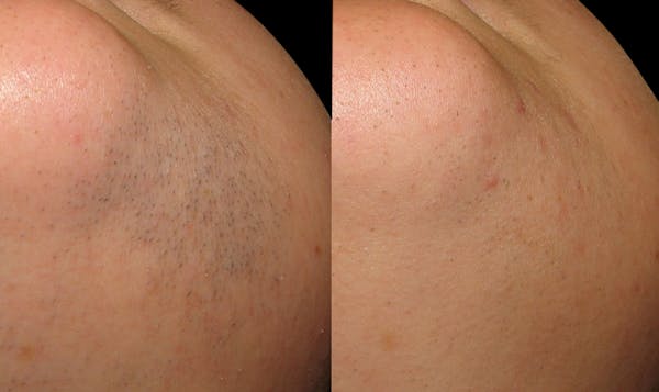 Laser Hair Removal Before & After Gallery - Patient 258233 - Image 1