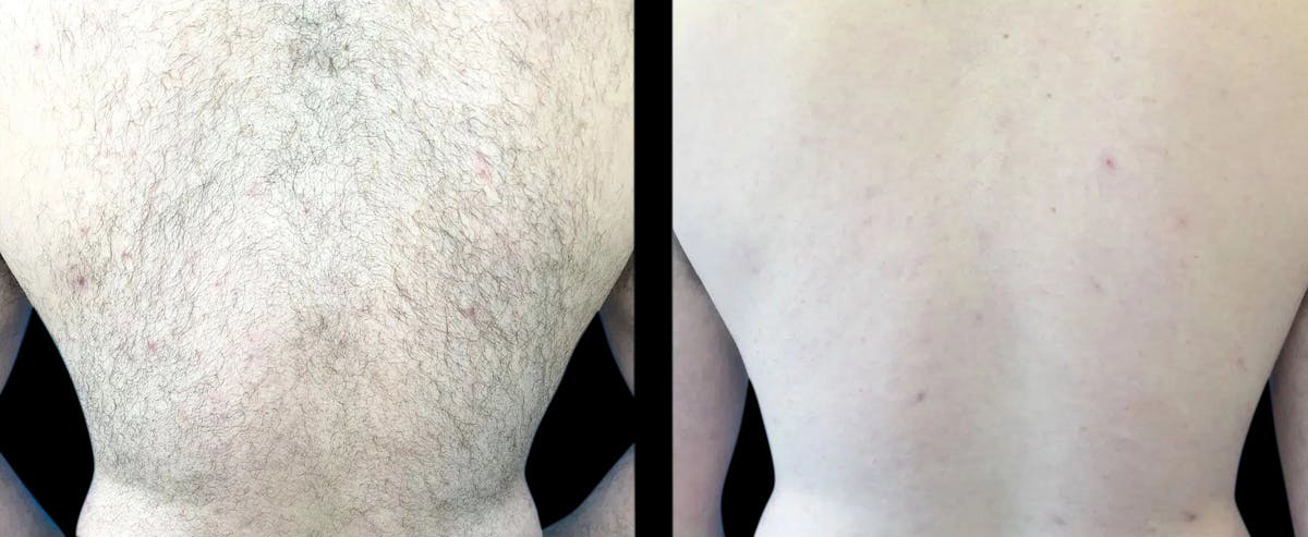 Laser Hair Removal Before & After Gallery - Patient 200253 - Image 1