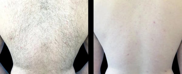 Laser Hair Removal Before & After Gallery - Patient 200253 - Image 1