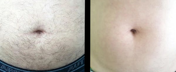 Laser Hair Removal Before & After Gallery - Patient 247316 - Image 1