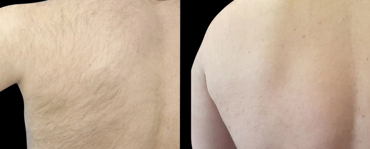 Laser Hair Removal Before & After Gallery - Patient 320004 - Image 1