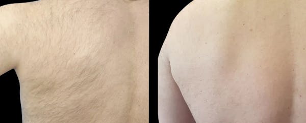 Laser Hair Removal Before & After Gallery - Patient 320004 - Image 1
