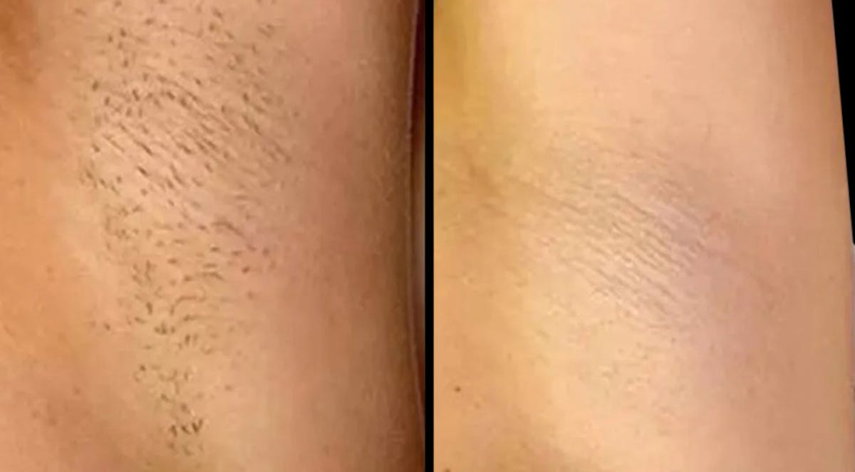 Laser Hair Removal Before & After Gallery - Patient 226902 - Image 1