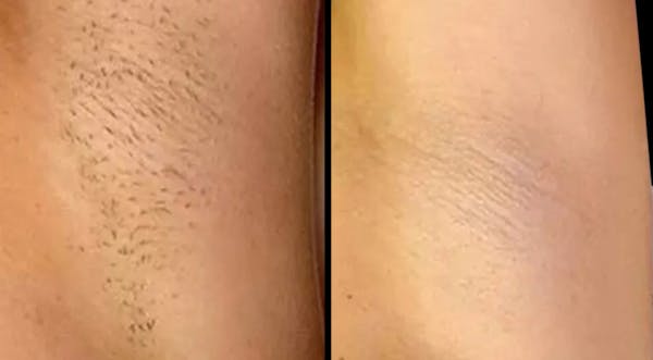Laser Hair Removal Before & After Gallery - Patient 226902 - Image 1