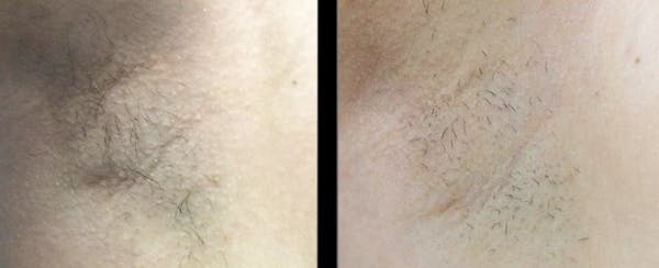 Laser Hair Removal Before & After Gallery - Patient 290760 - Image 1