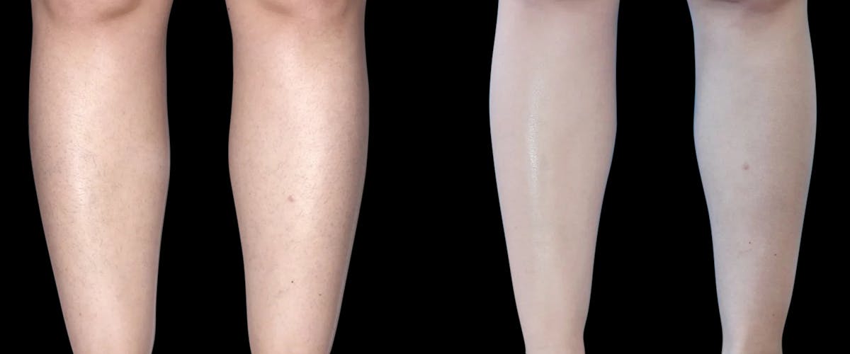 Laser Hair Removal Before & After Gallery - Patient 402218 - Image 1