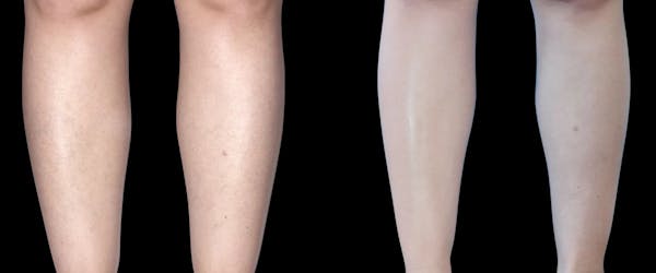 Laser Hair Removal Before & After Gallery - Patient 402218 - Image 1