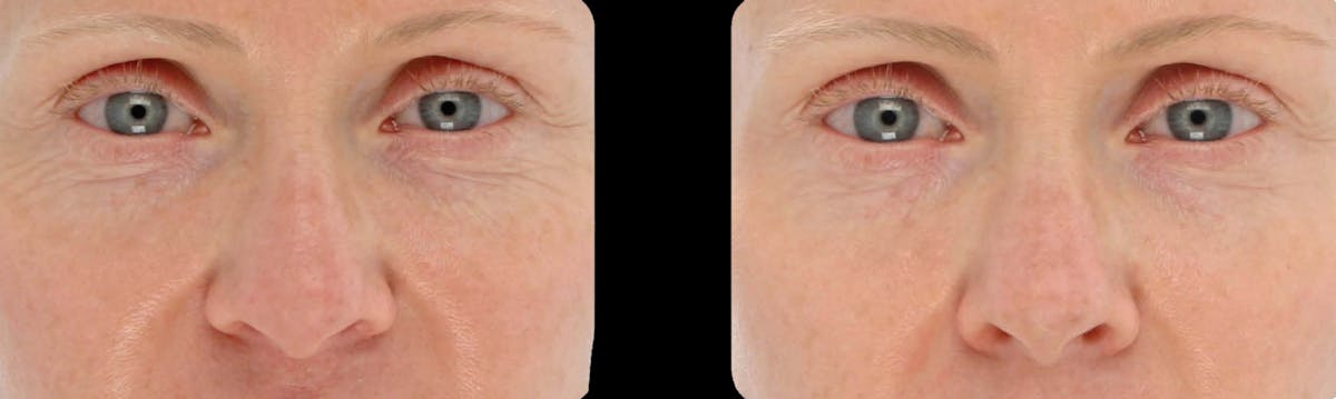 LightStim®  Before & After Gallery - Patient 350023 - Image 1