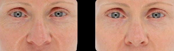 LightStim®  Before & After Gallery - Patient 350023 - Image 1