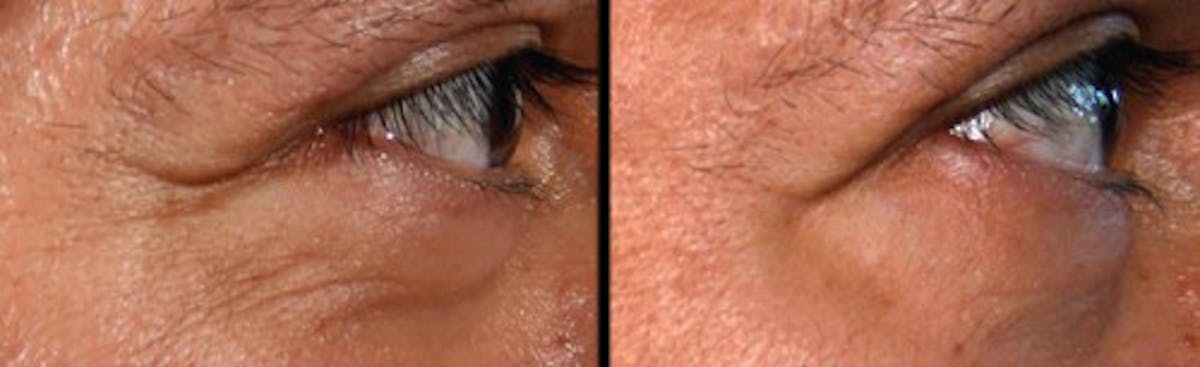 LightStim®  Before & After Gallery - Patient 391120 - Image 1