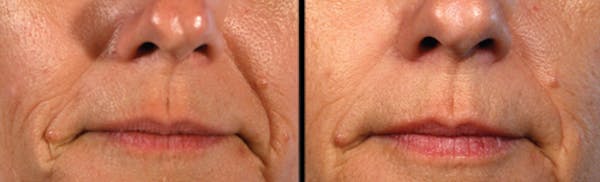 LightStim®  Before & After Gallery - Patient 375526 - Image 1