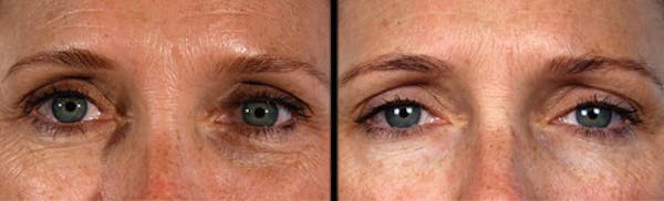 LightStim®  Before & After Gallery - Patient 312454 - Image 1