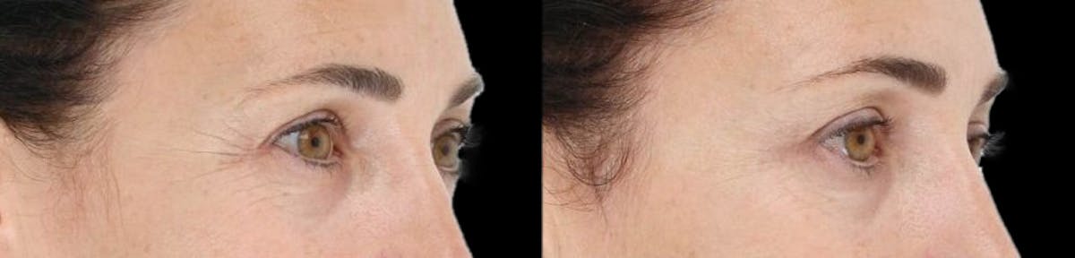 LightStim®  Before & After Gallery - Patient 356397 - Image 1