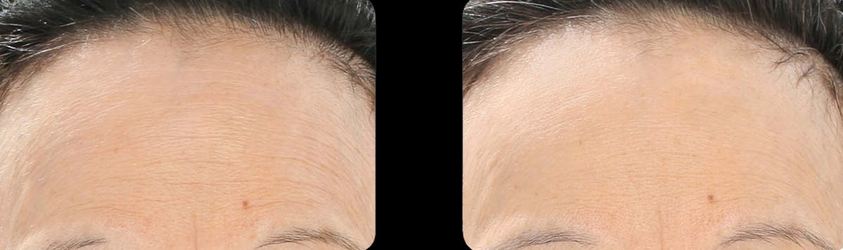 LightStim®  Before & After Gallery - Patient 315138 - Image 1
