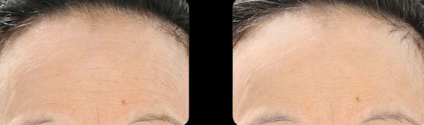 LightStim®  Before & After Gallery - Patient 315138 - Image 1
