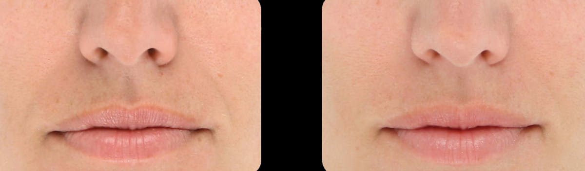 LightStim®  Before & After Gallery - Patient 308555 - Image 1