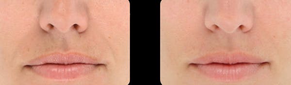 LightStim®  Before & After Gallery - Patient 308555 - Image 1