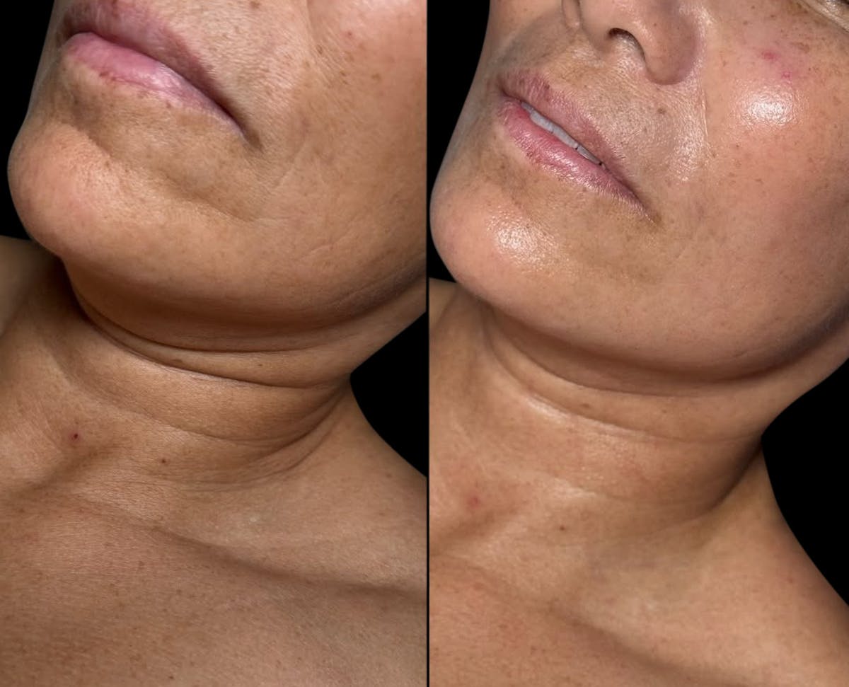 LightStim®  Before & After Gallery - Patient 407620 - Image 2