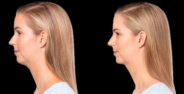 Lipo Dissolver - Kybella Before & After Gallery - Patient 136991 - Image 1