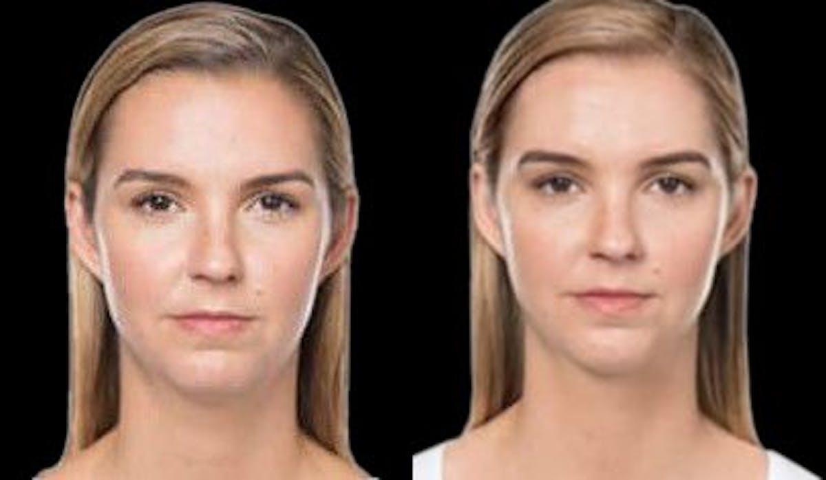 Lipo Dissolver - Kybella Before & After Gallery - Patient 136991 - Image 2