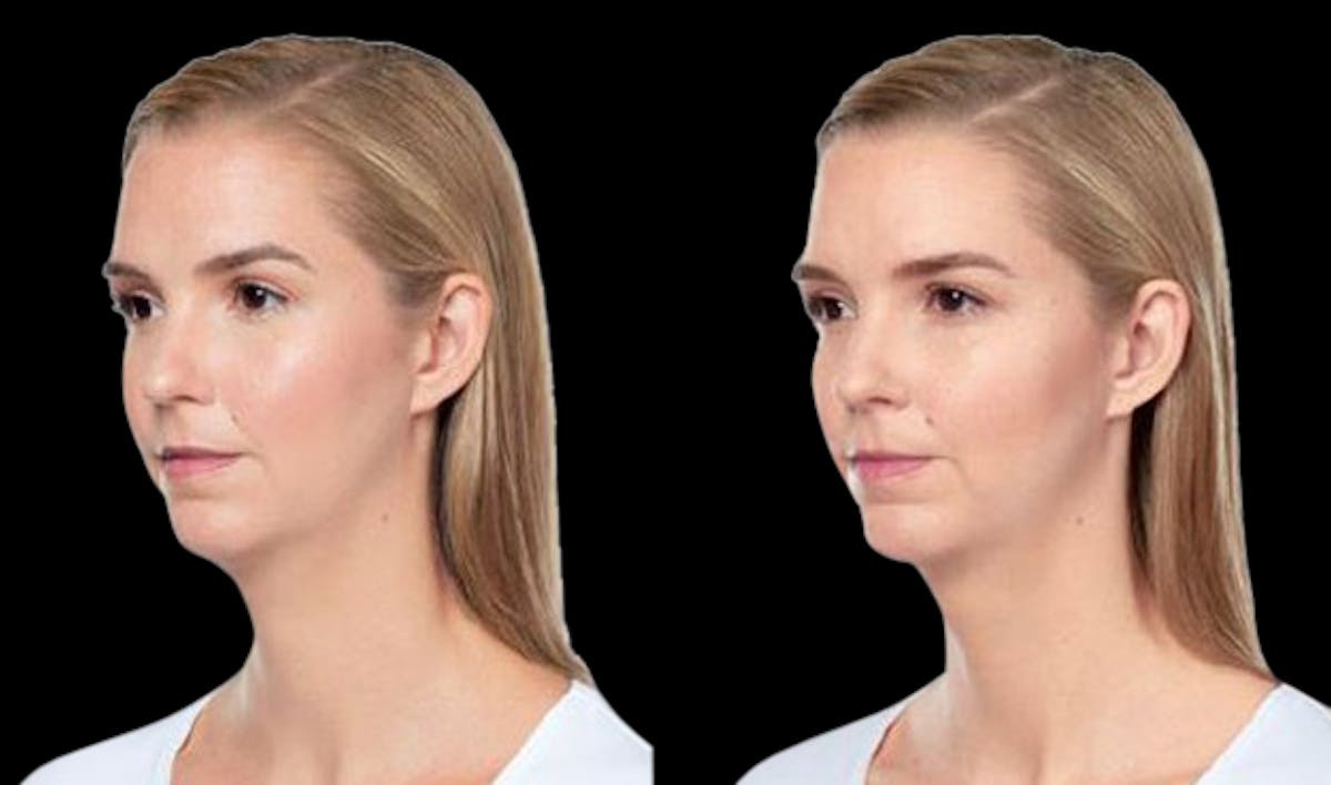 Lipo Dissolver - Kybella Before & After Gallery - Patient 136991 - Image 3
