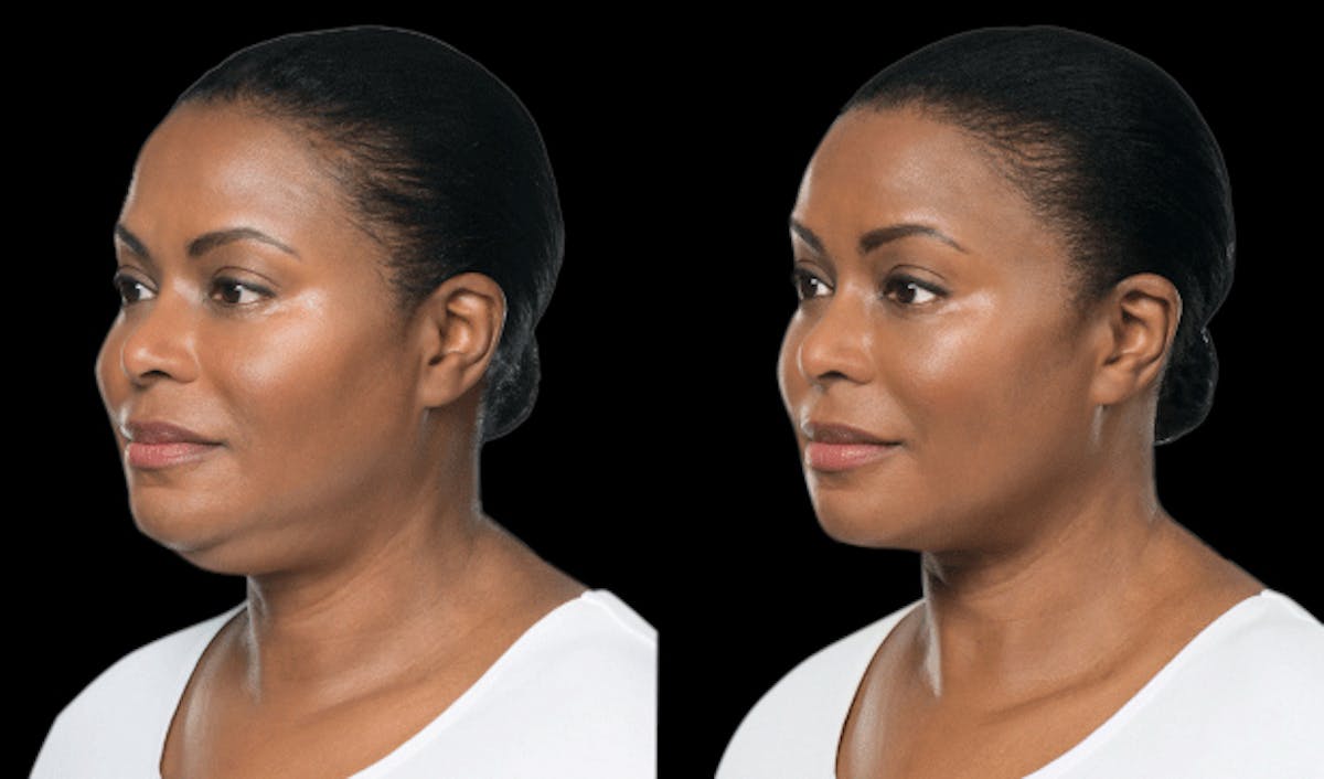Lipo Dissolver - Kybella Before & After Gallery - Patient 320529 - Image 2