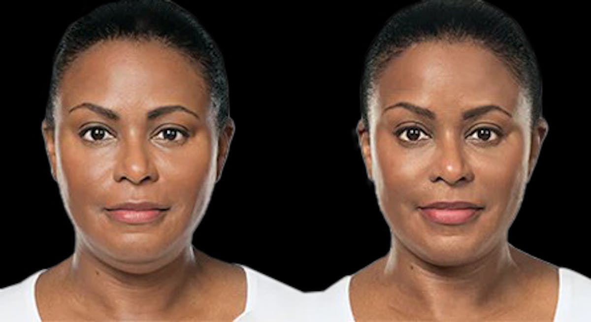 Lipo Dissolver - Kybella Before & After Gallery - Patient 320529 - Image 3