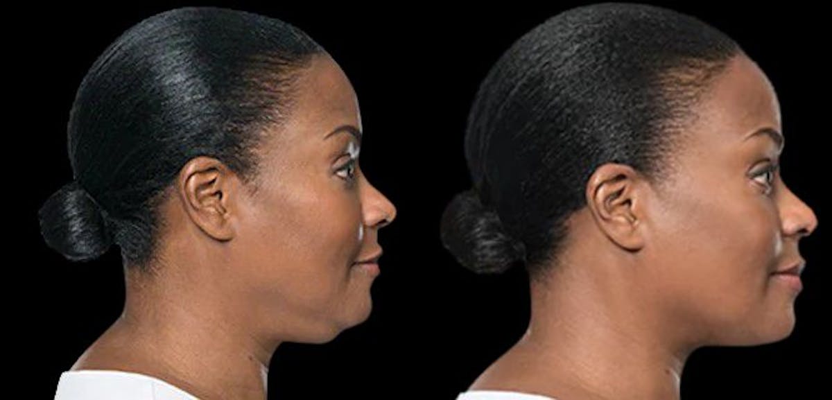 Lipo Dissolver - Kybella Before & After Gallery - Patient 320529 - Image 4