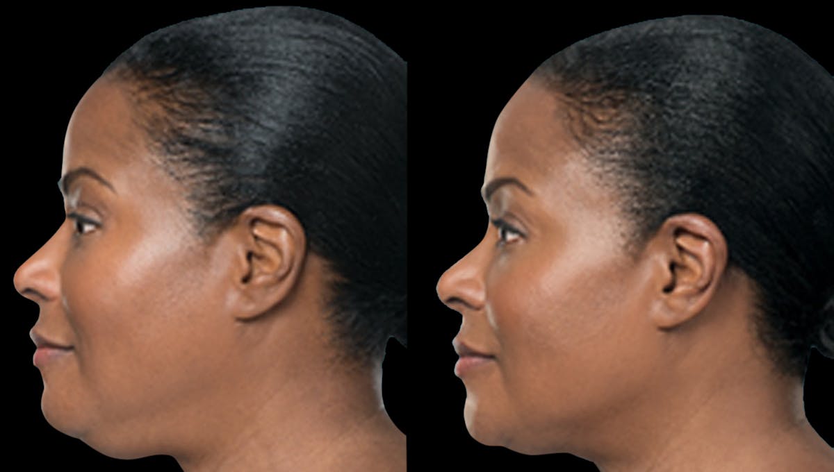 Lipo Dissolver - Kybella Before & After Gallery - Patient 320529 - Image 1