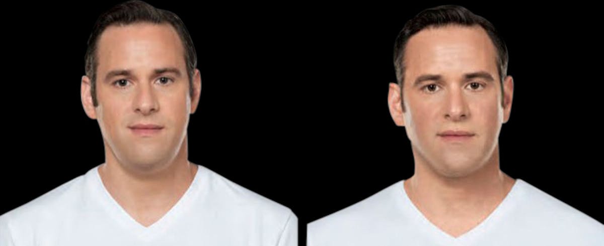 Lipo Dissolver - Kybella Before & After Gallery - Patient 240528 - Image 3