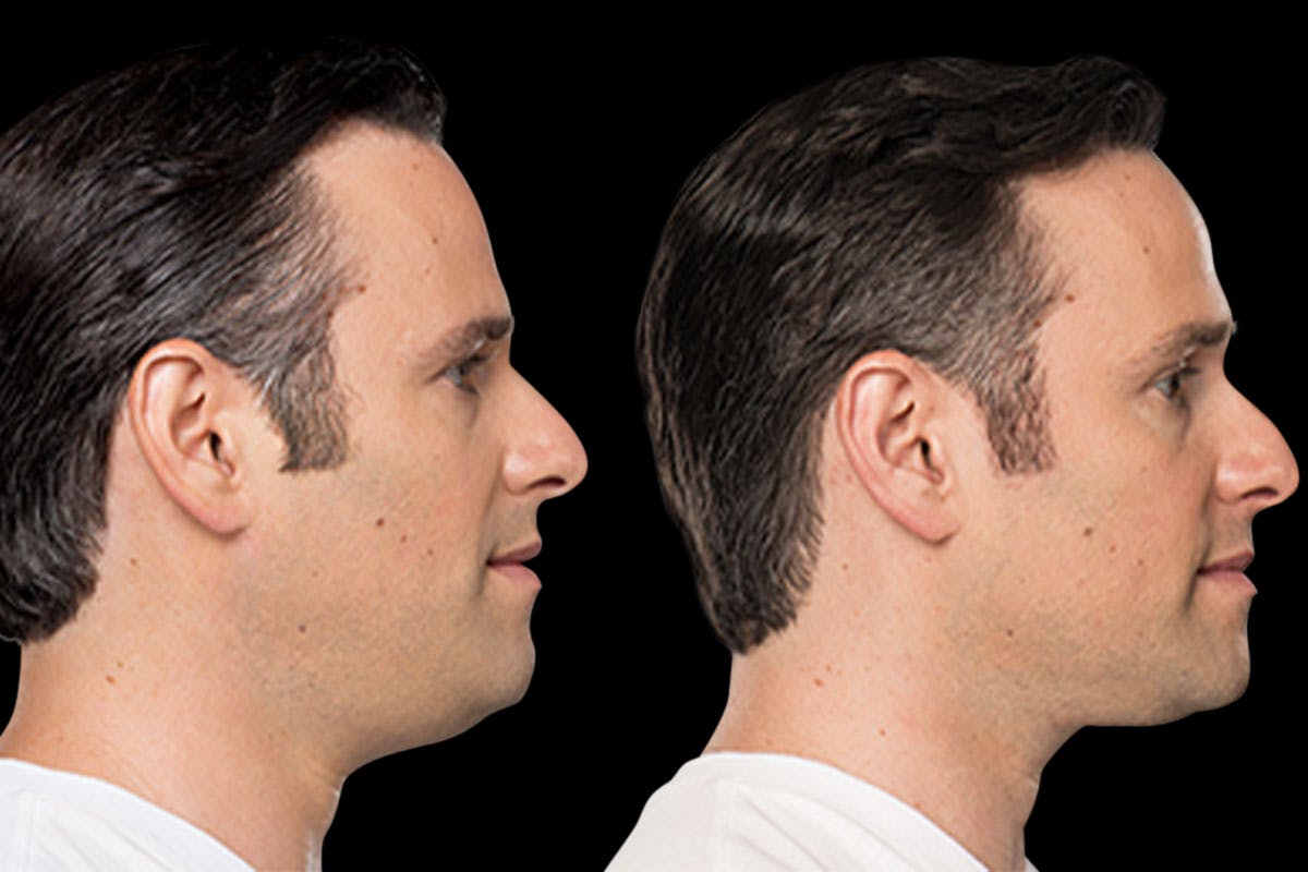 Lipo Dissolver - Kybella Before & After Gallery - Patient 240528 - Image 4