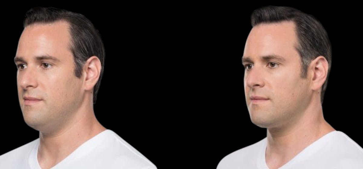 Lipo Dissolver - Kybella Before & After Gallery - Patient 240528 - Image 2